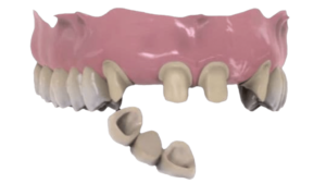 Ponte-su-denti-1024x614-1.png